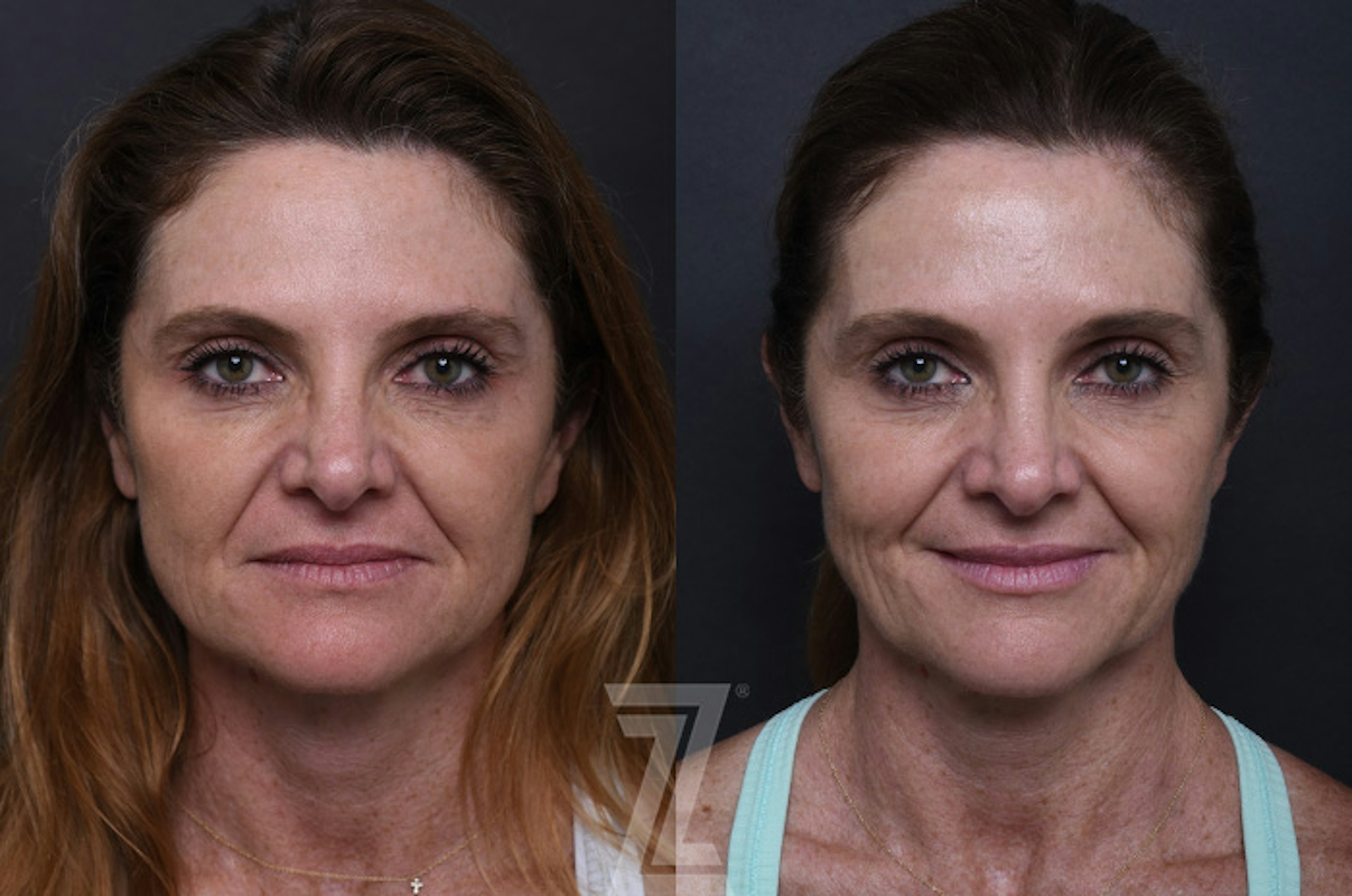 Austin ezGEL Before & After Gallery - Patient 129025 - Image 2 - The Piazza Center