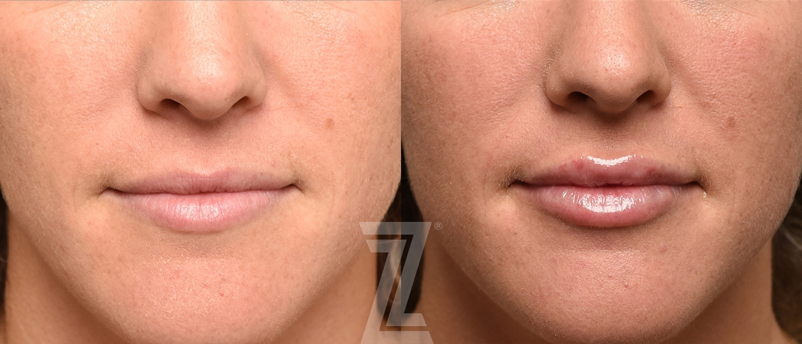 Austin Injectable Fillers Before & After Gallery - Patient 696292 - Image 1 - The Piazza Center