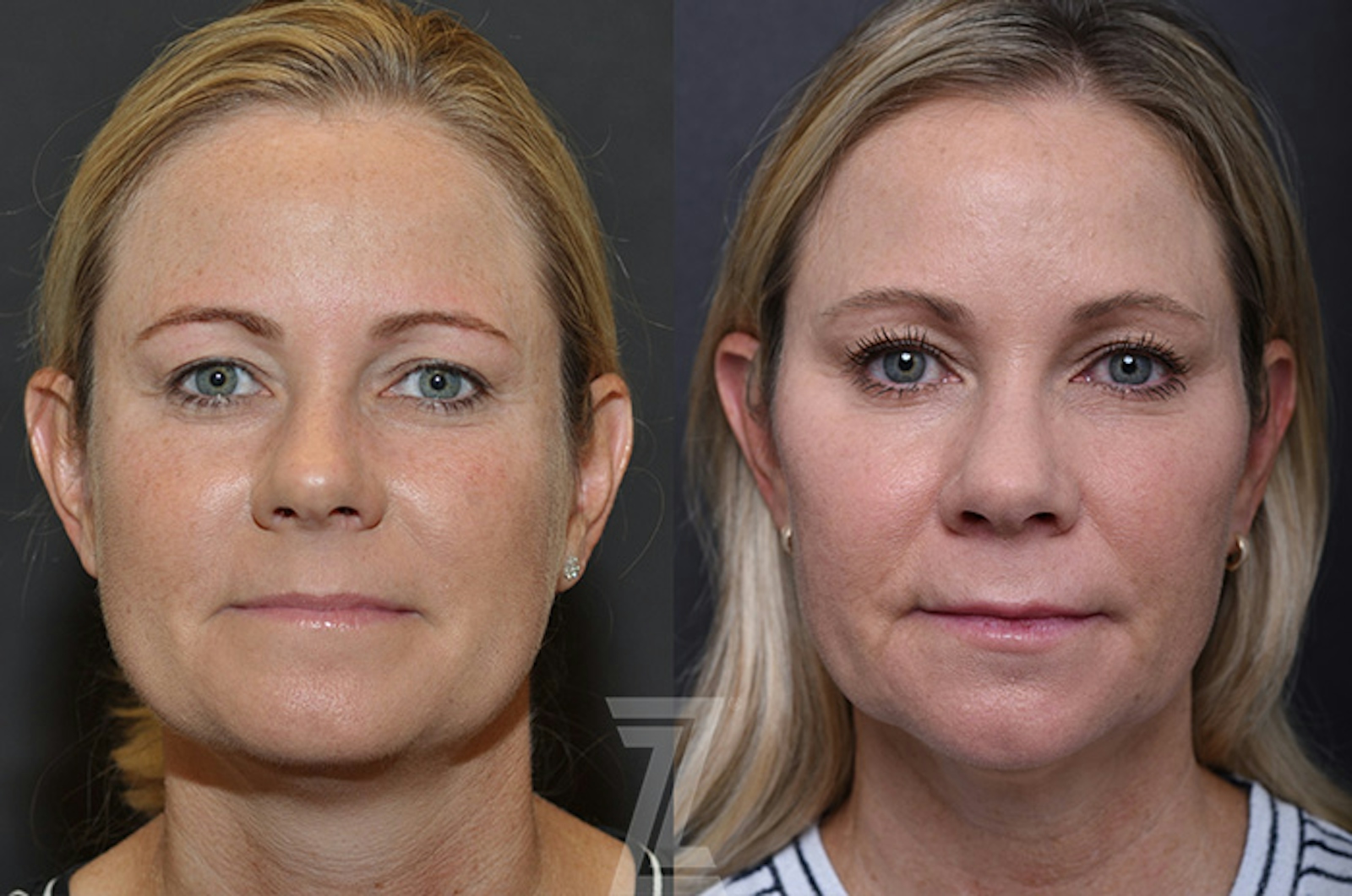 Austin Injectable Fillers Before & After Gallery - Patient 839826 - Image 1 - The Piazza Center