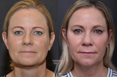 Austin Injectable Fillers Before & After Gallery - Patient 839826 - Image 1 - The Piazza Center