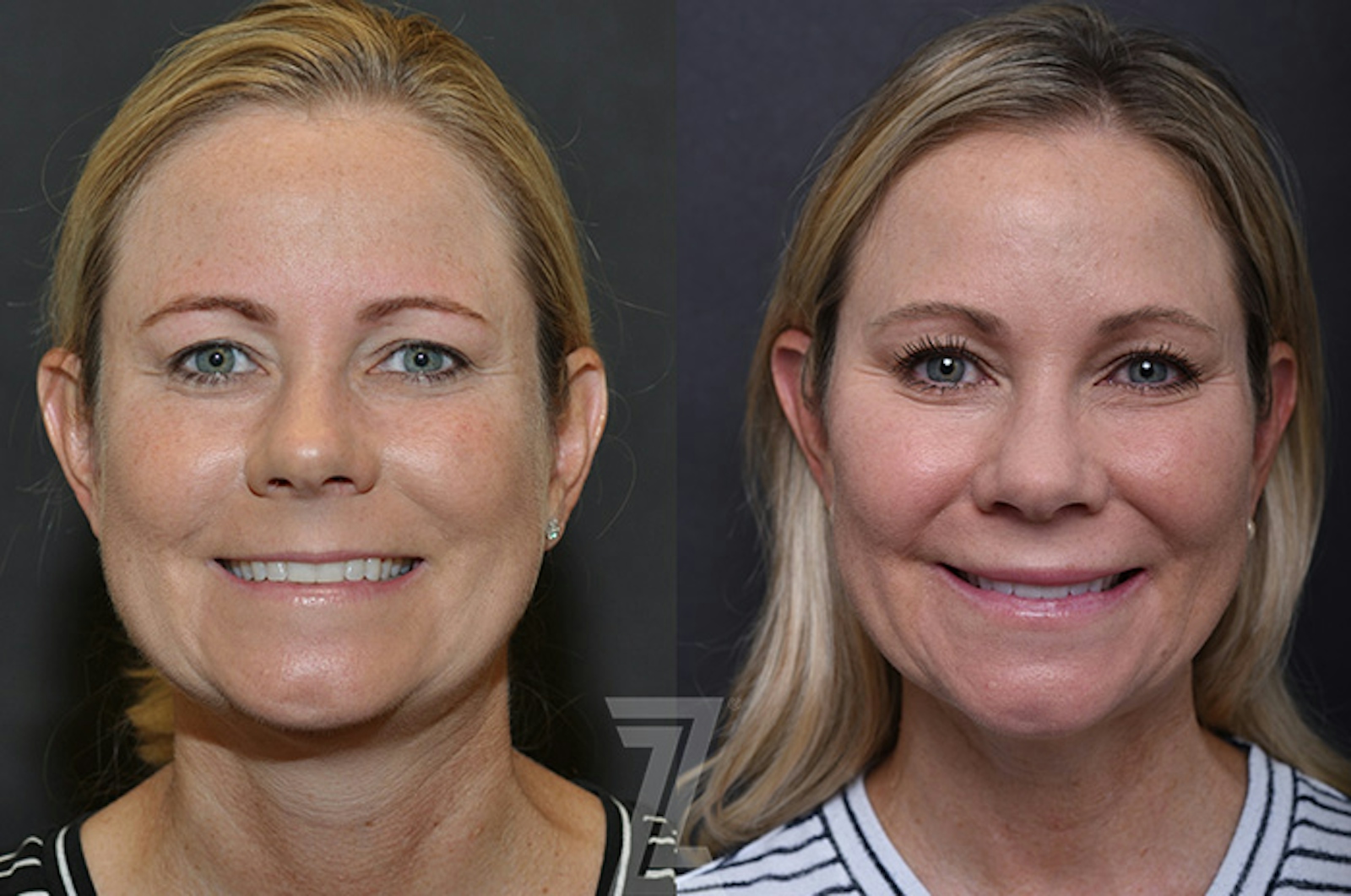 Austin Injectable Fillers Before & After Gallery - Patient 839826 - Image 2 - The Piazza Center