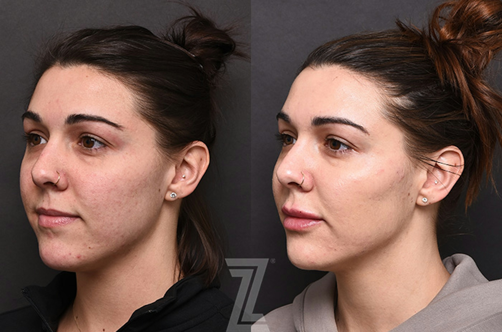 Austin Injectable Fillers Before & After Gallery - Patient 342808 - Image 1 - The Piazza Center