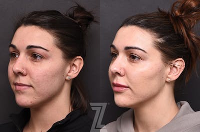 Austin Injectable Fillers Before & After Gallery - Patient 342808 - Image 1 - The Piazza Center