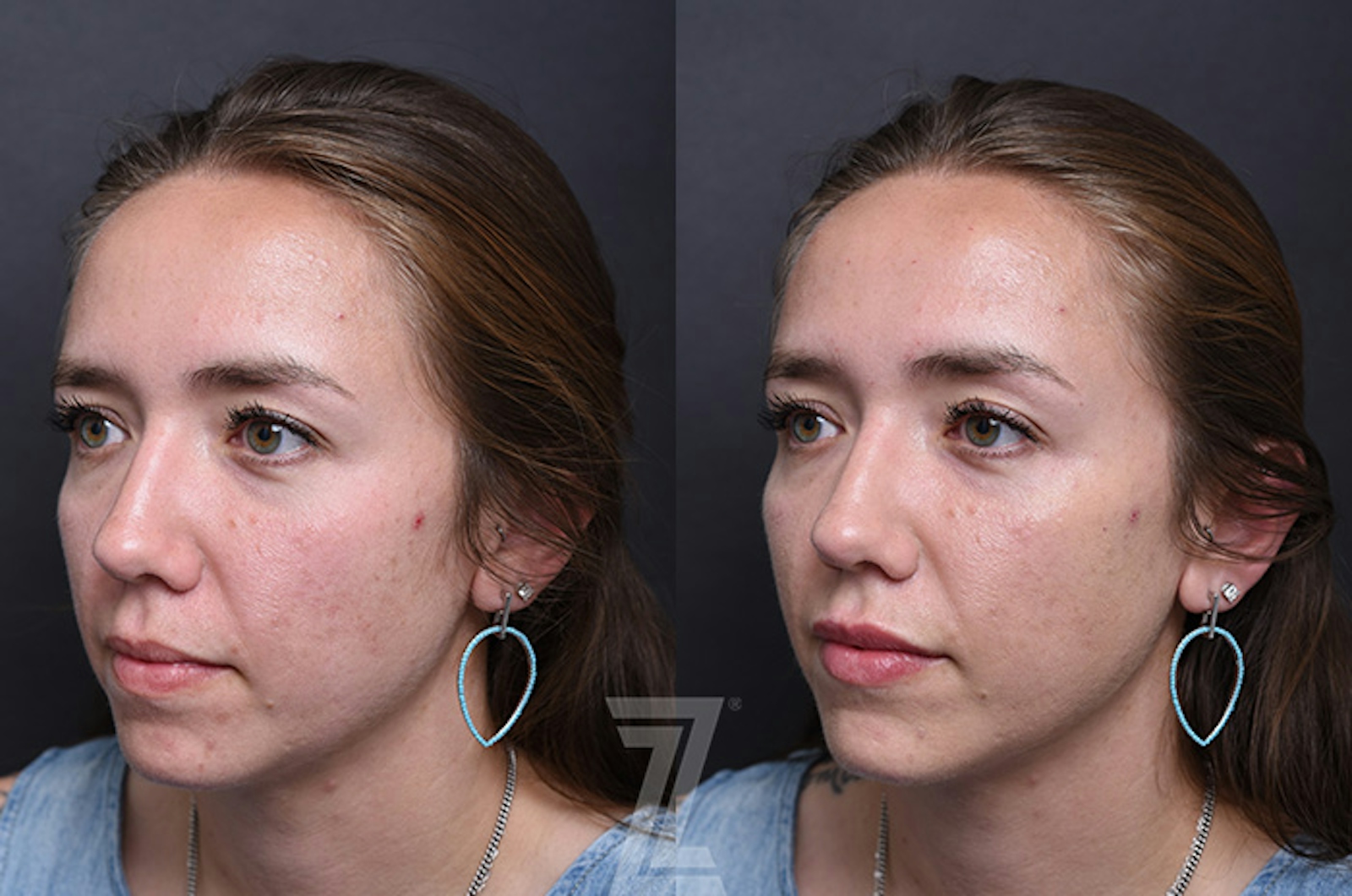 Austin Injectable Fillers Before & After Gallery - Patient 402298 - Image 1 - The Piazza Center