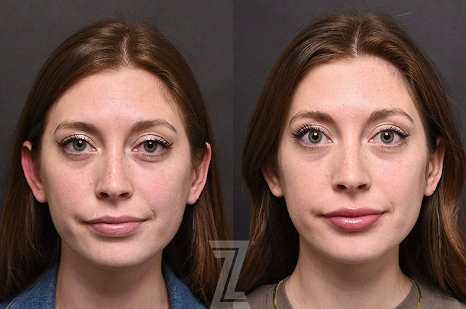 Austin Injectable Fillers Before & After Gallery - Patient 922179 - Image 1 - The Piazza Center