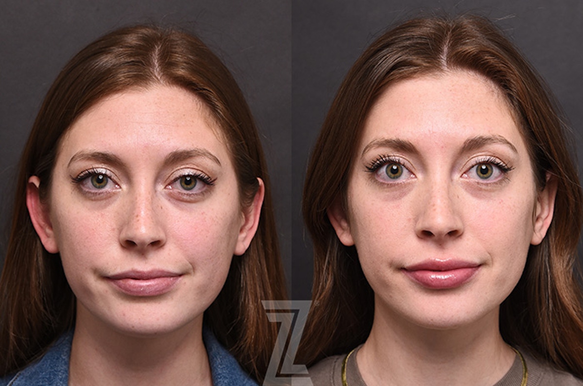 Austin Injectable Fillers Before & After Gallery - Patient 922179 - Image 1 - The Piazza Center