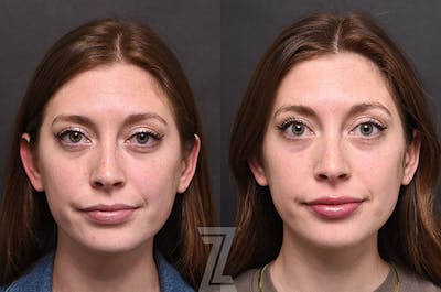 Austin Injectable Fillers Before & After Gallery - Patient 922179 - Image 1 - The Piazza Center