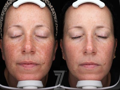 Austin Moxi Before & After Gallery - Patient 355580 - Image 1 - The Piazza Center