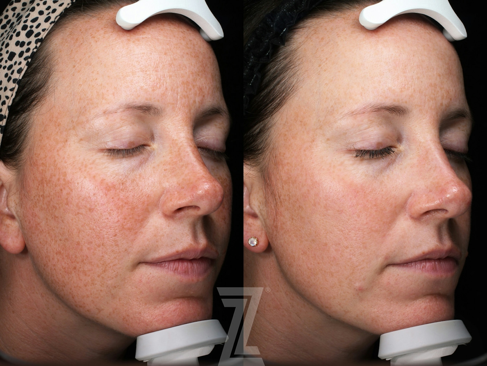 Austin Moxi Before & After Gallery - Patient 355580 - Image 2 - The Piazza Center