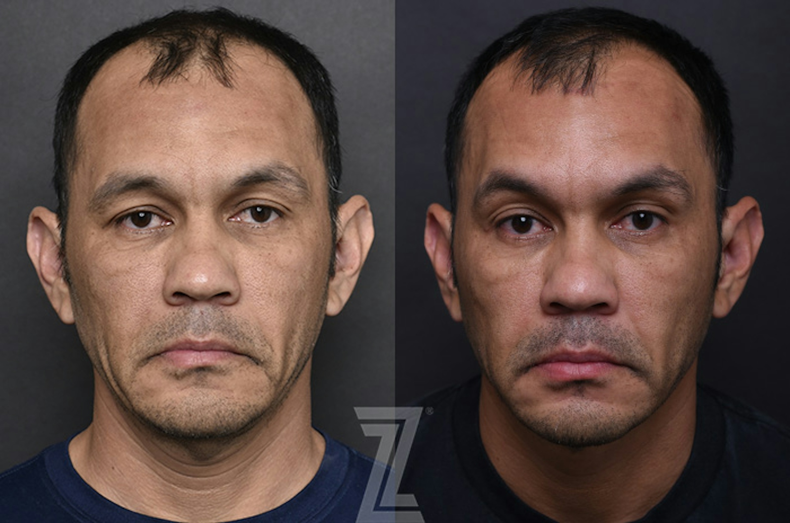 Austin Sculptra® Before & After Gallery - Patient 149645 - Image 1 - The Piazza Center
