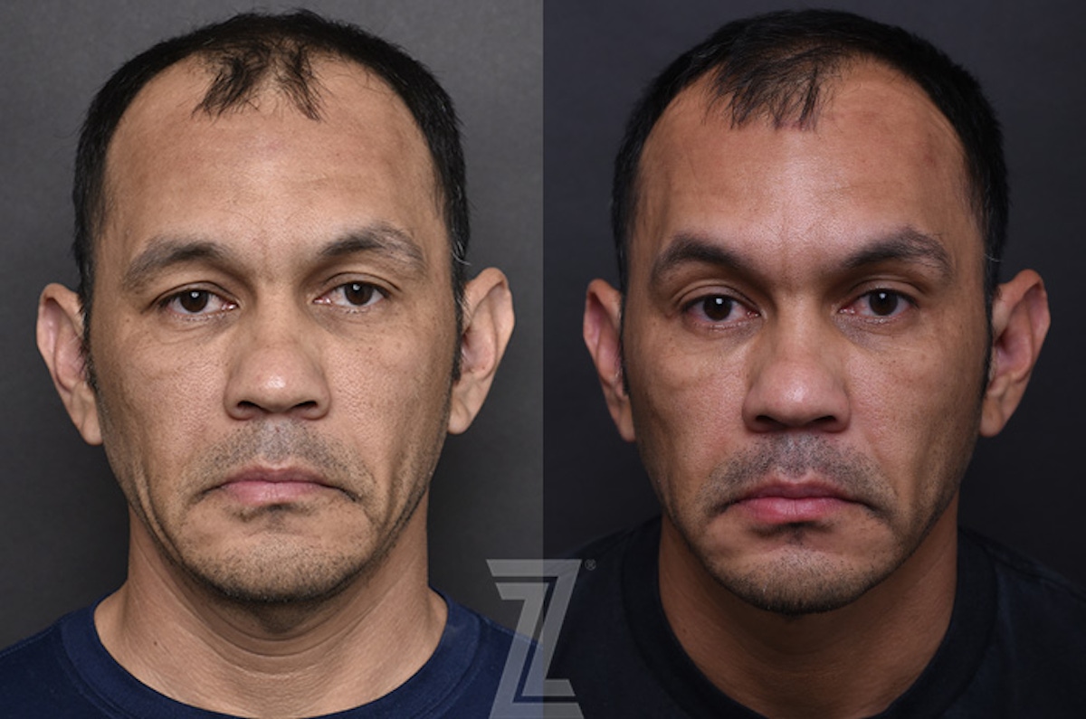 Austin Sculptra® Before & After Gallery - Patient 149645 - Image 1 - The Piazza Center