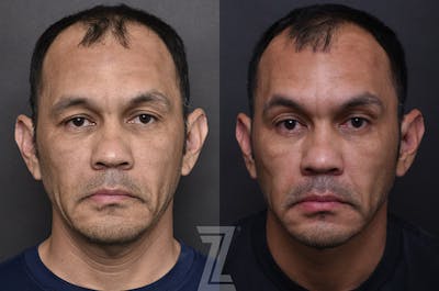 Austin Male Injectables Before & After Gallery - Patient 325552 - Image 1 - The Piazza Center