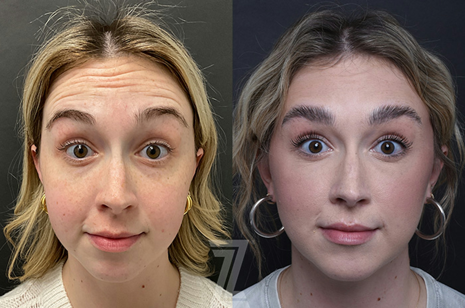Austin Wrinkle Relaxers Before & After Gallery - Patient 114945 - Image 1 - The Piazza Center