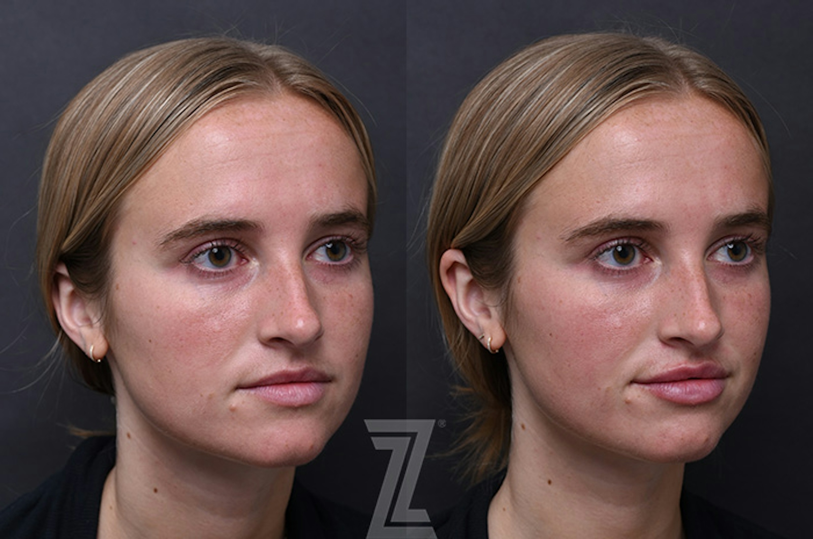 Austin Injectable Fillers Before & After Gallery - Patient 208728 - Image 1 - The Piazza Center