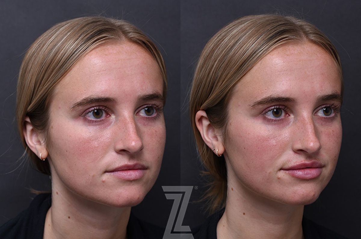 Austin Injectable Fillers Before & After Gallery - Patient 208728 - Image 1 - The Piazza Center