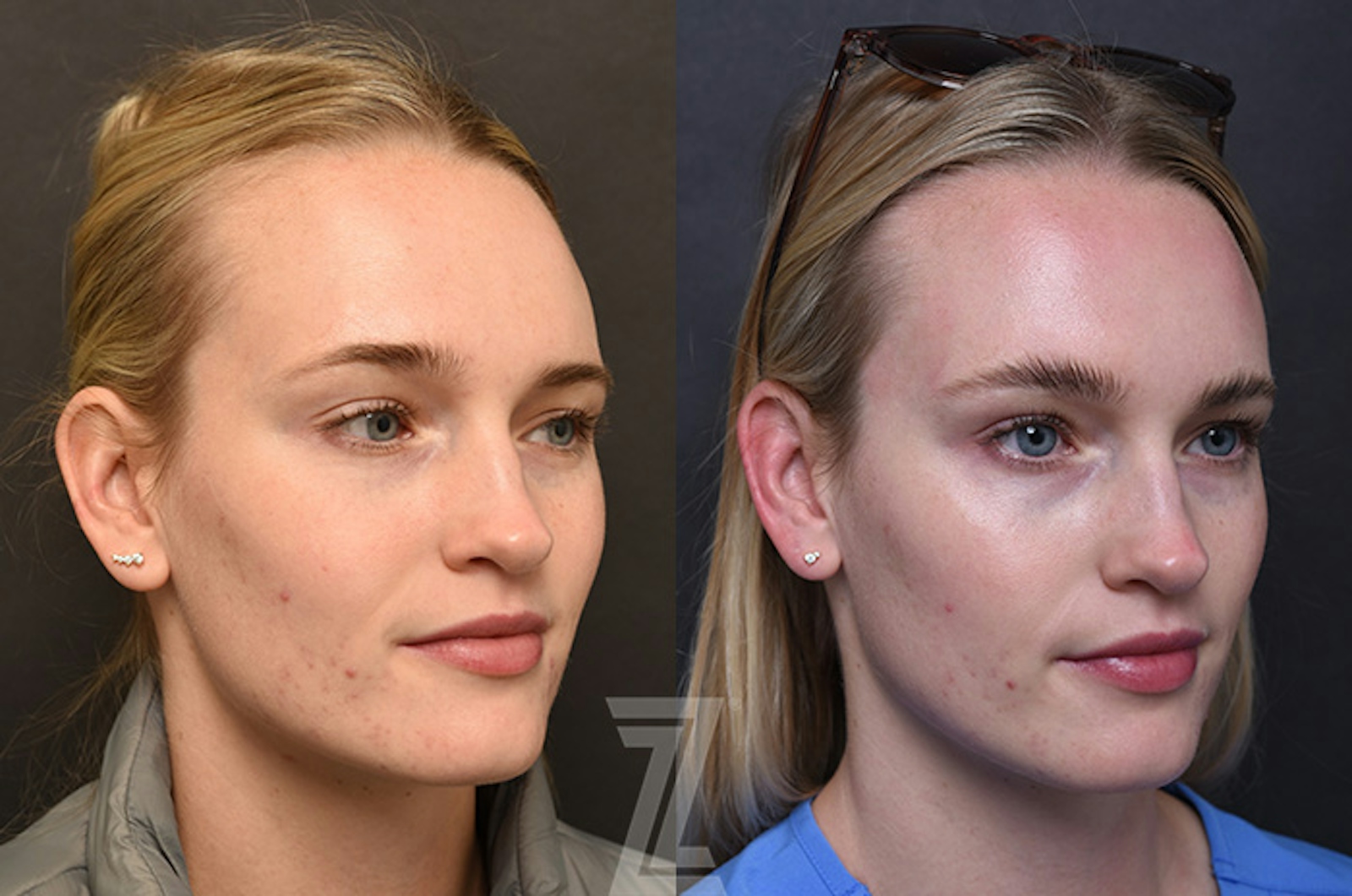 Austin Wrinkle Relaxers Before & After Gallery - Patient 352814 - Image 1 - The Piazza Center