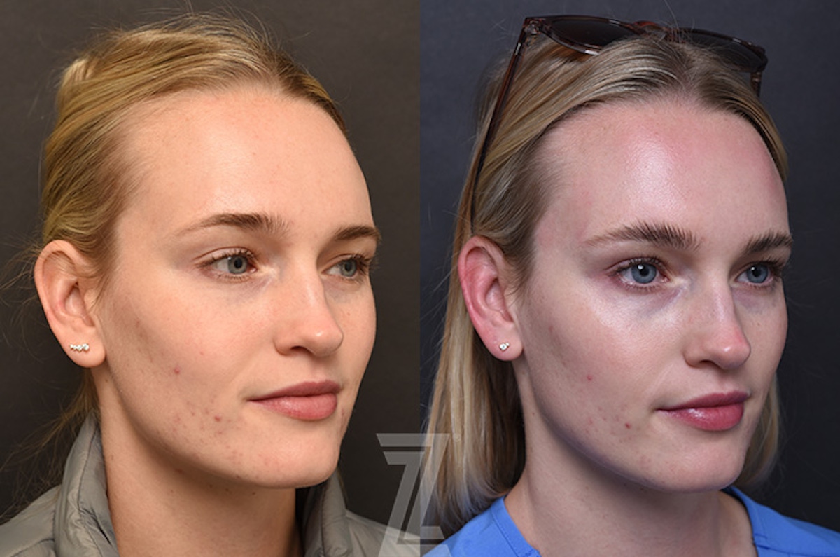 Austin Wrinkle Relaxers Before & After Gallery - Patient 352814 - Image 1 - The Piazza Center