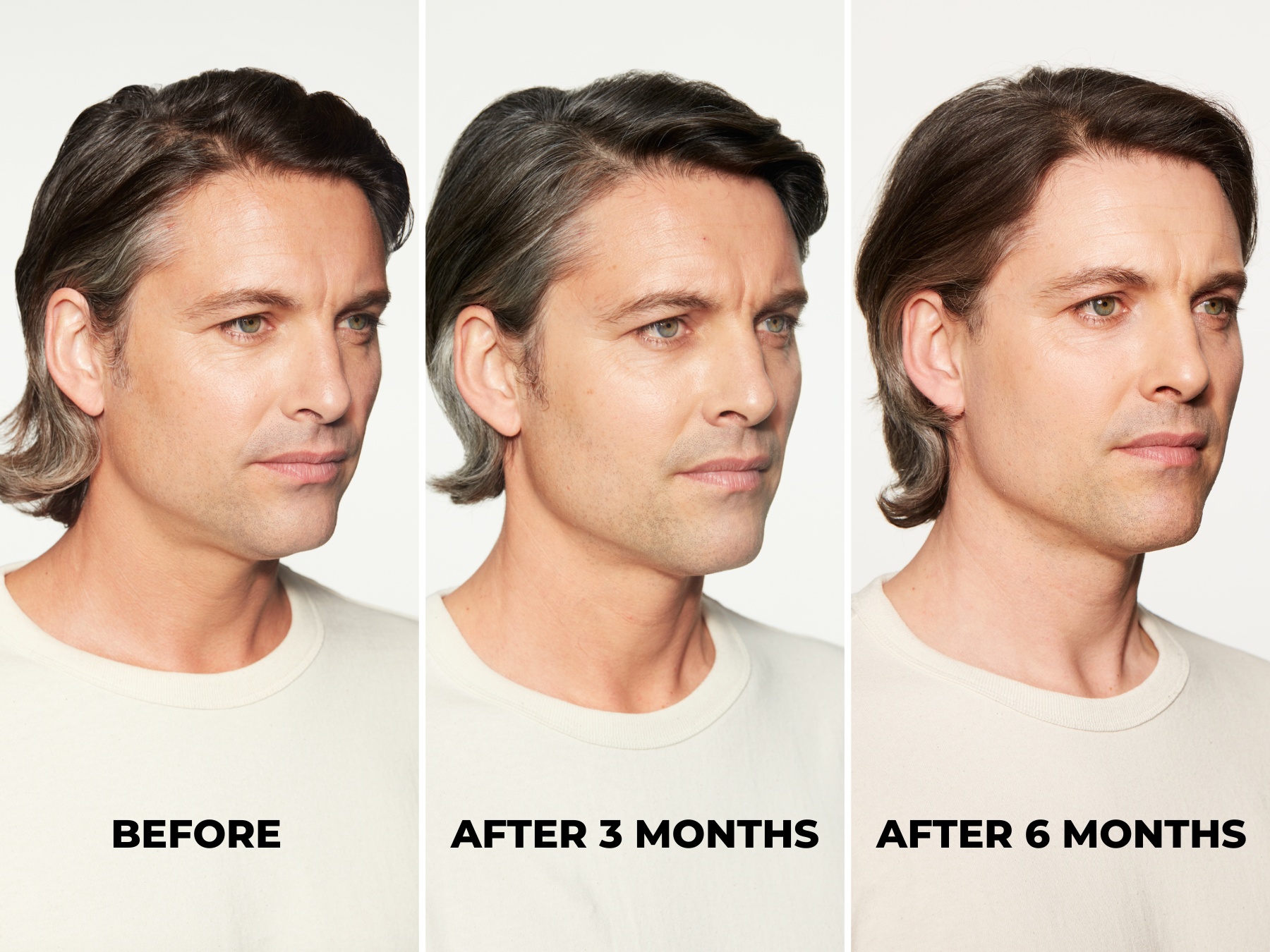 Before and After Sculptra vs Fillers