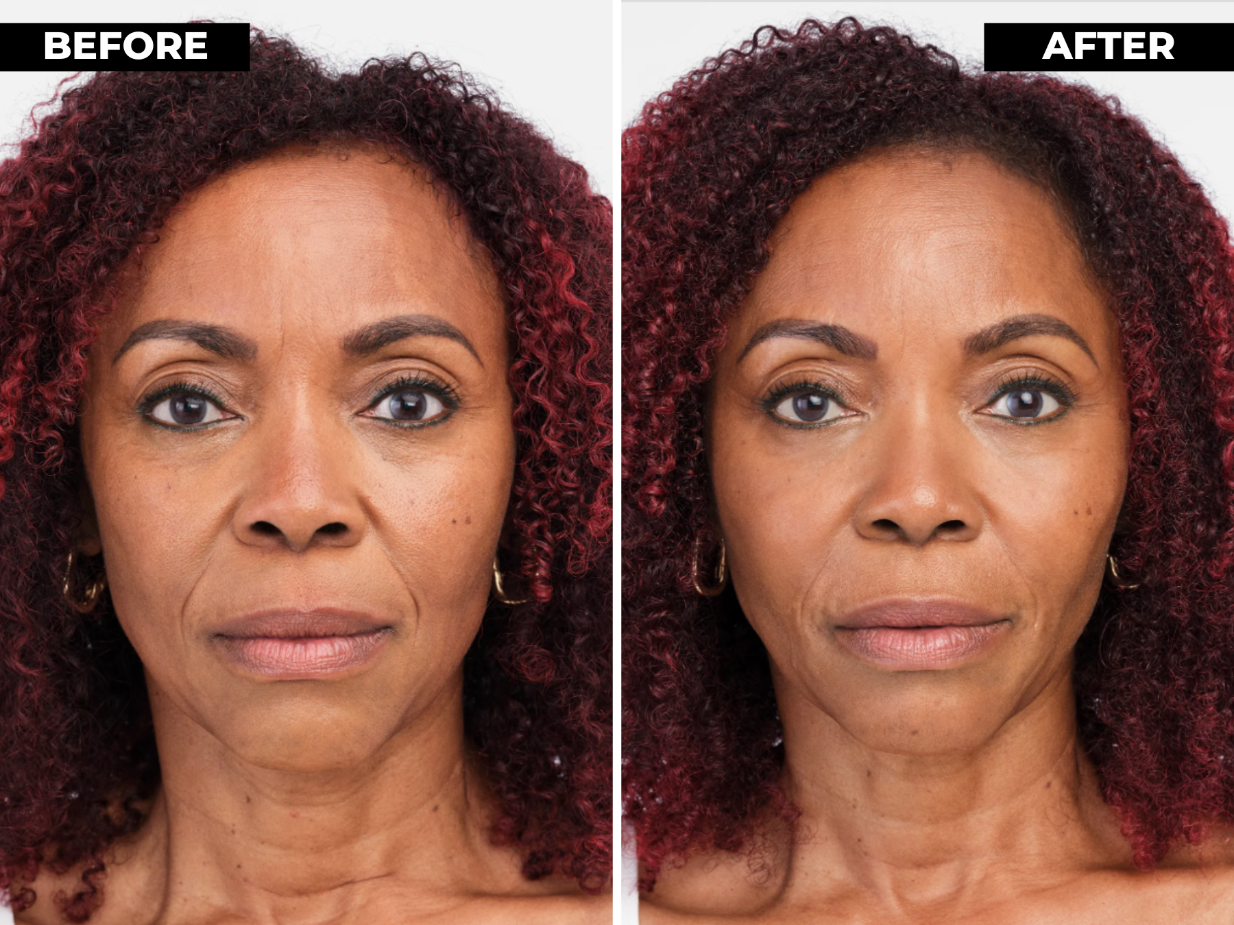 Radiesse filler results