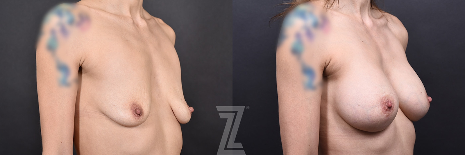 Austin Before & After Oblique View 40-year-old Mother of Two, Underwent Revision Breast Augmentation and Mastopexy to Address Sagging and Volume Loss Post-Breastfeeding in Austin, TX by Dr. Rocco Piazza - The Piazza Center