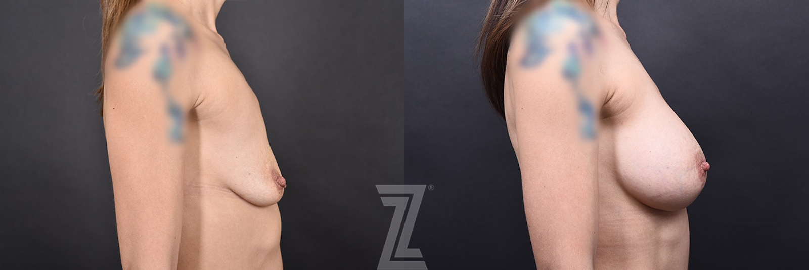 Austin Before & After Lateral View of 40-year-old Mother of Two, Underwent Revision Breast Augmentation and Mastopexy to Address Sagging and Volume Loss Post-Breastfeeding in Austin, TX by Dr. Rocco Piazza - The Piazza Center