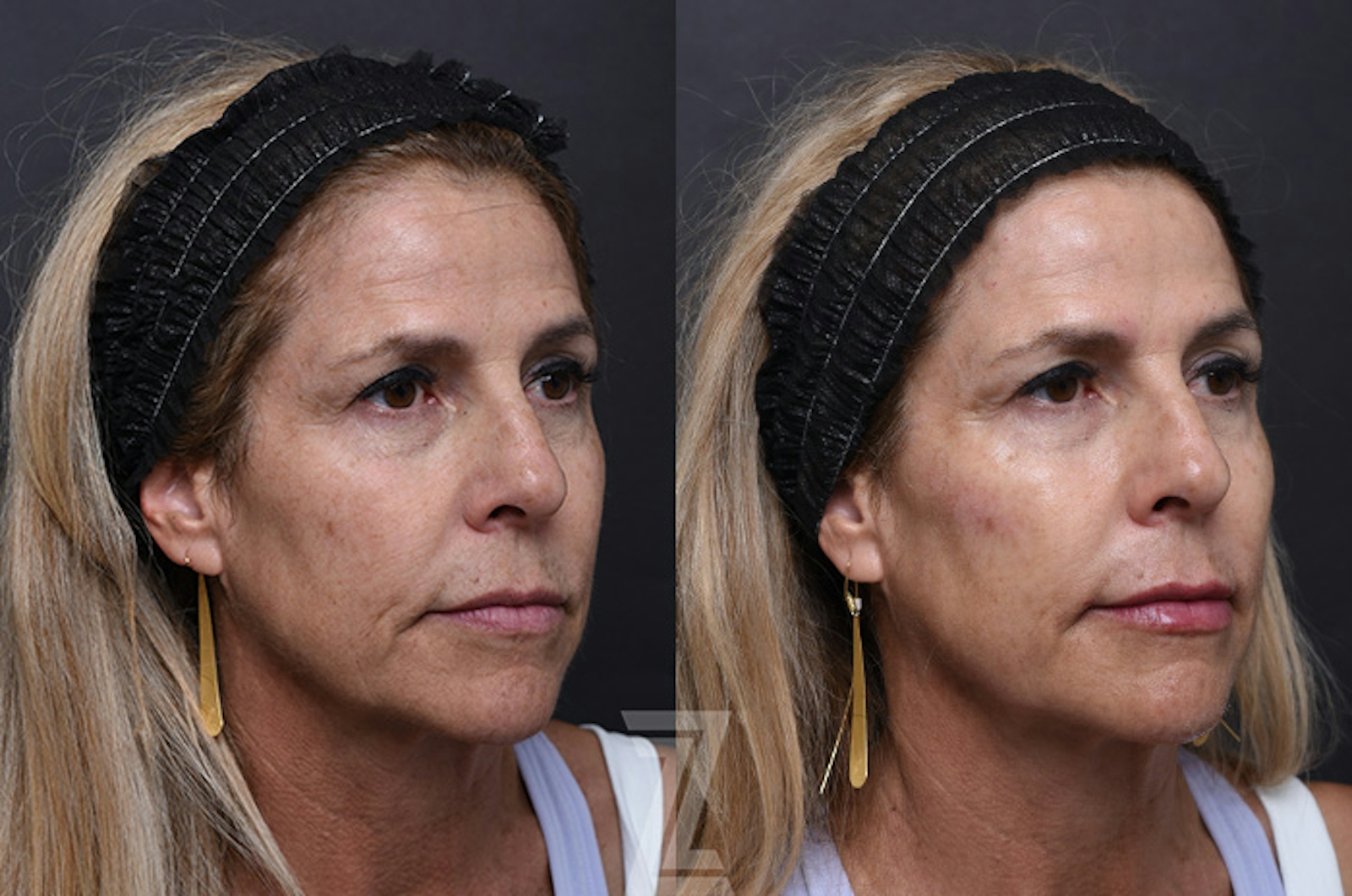 Austin Wrinkle Relaxers Before & After Gallery - Patient 294390 - Image 1 - The Piazza Center