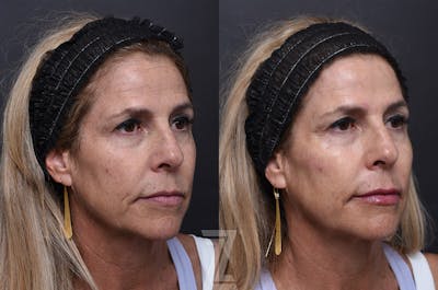 Austin Injectable Fillers Before & After Gallery - Patient 901099 - Image 1 - The Piazza Center