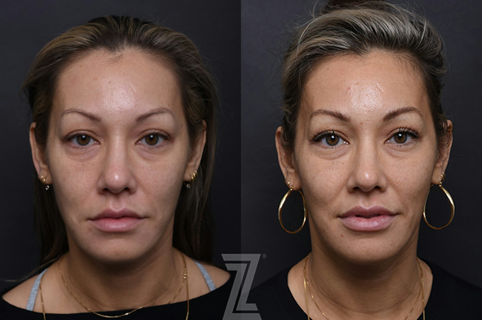 Austin Injectable Fillers Before & After Gallery - Patient 407560 - Image 1 - The Piazza Center