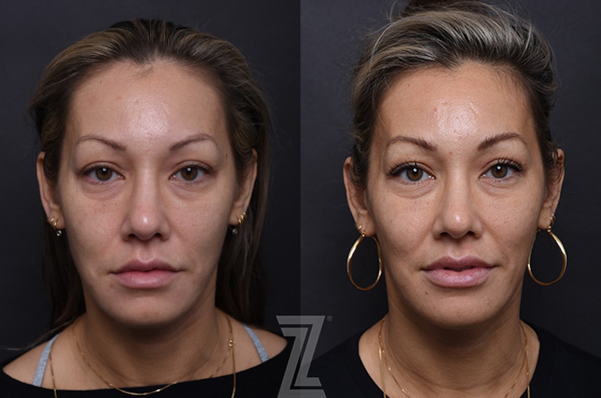 Austin Injectable Fillers Before & After Gallery - Patient 407560 - Image 1 - The Piazza Center