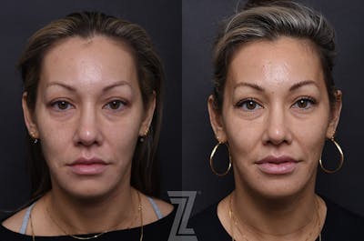 Austin Injectable Fillers Before & After Gallery - Patient 407560 - Image 1 - The Piazza Center