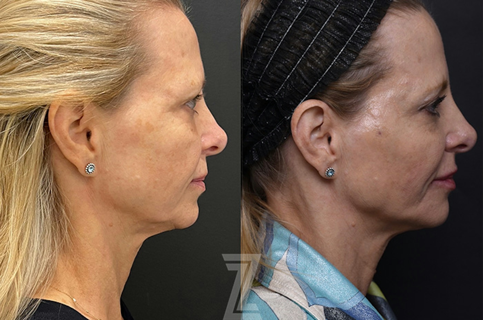 Austin Injectable Fillers Before & After Gallery - Patient 193776 - Image 1 - The Piazza Center