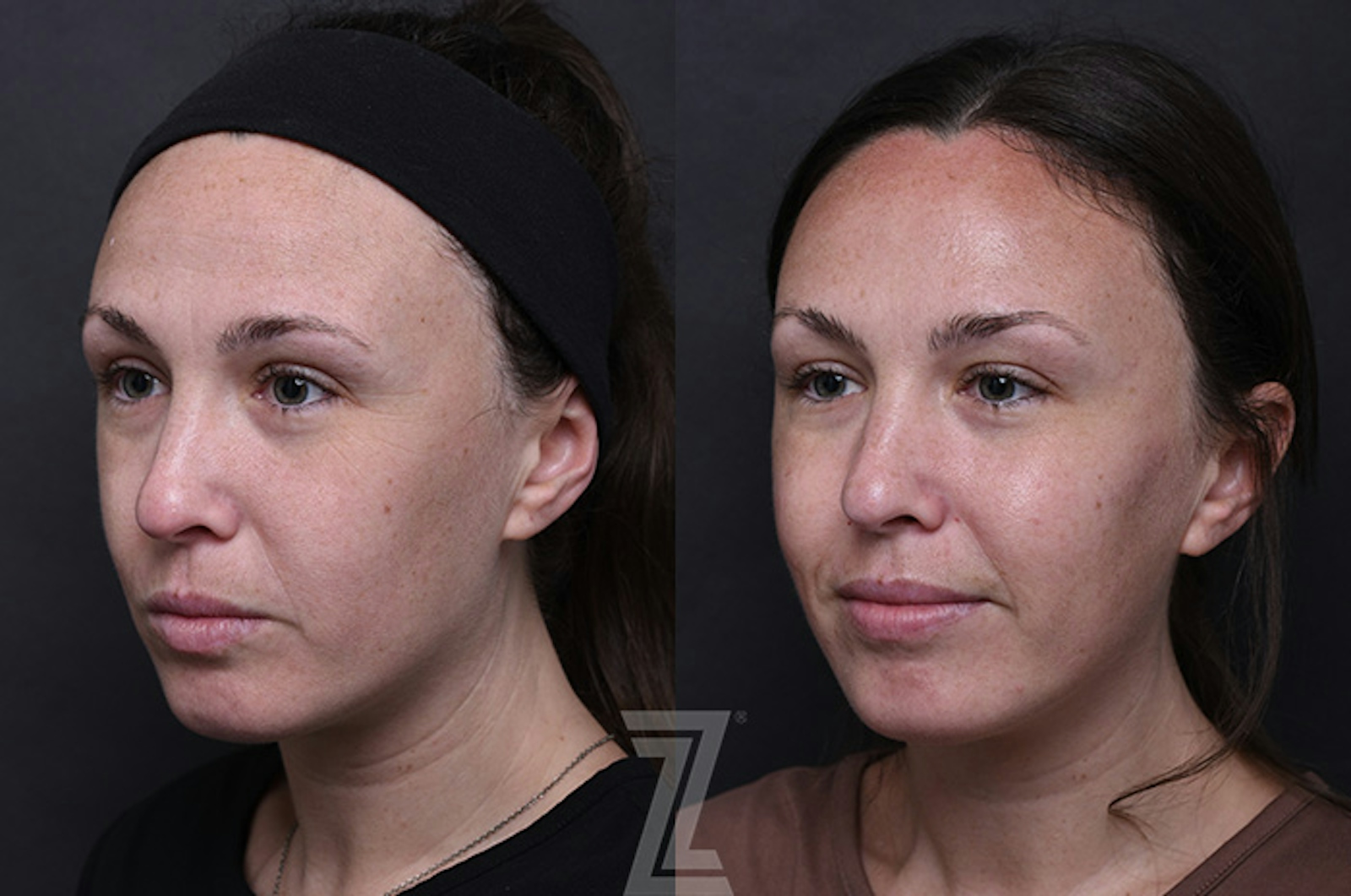 Austin Injectable Fillers Before & After Gallery - Patient 242235 - Image 2 - The Piazza Center