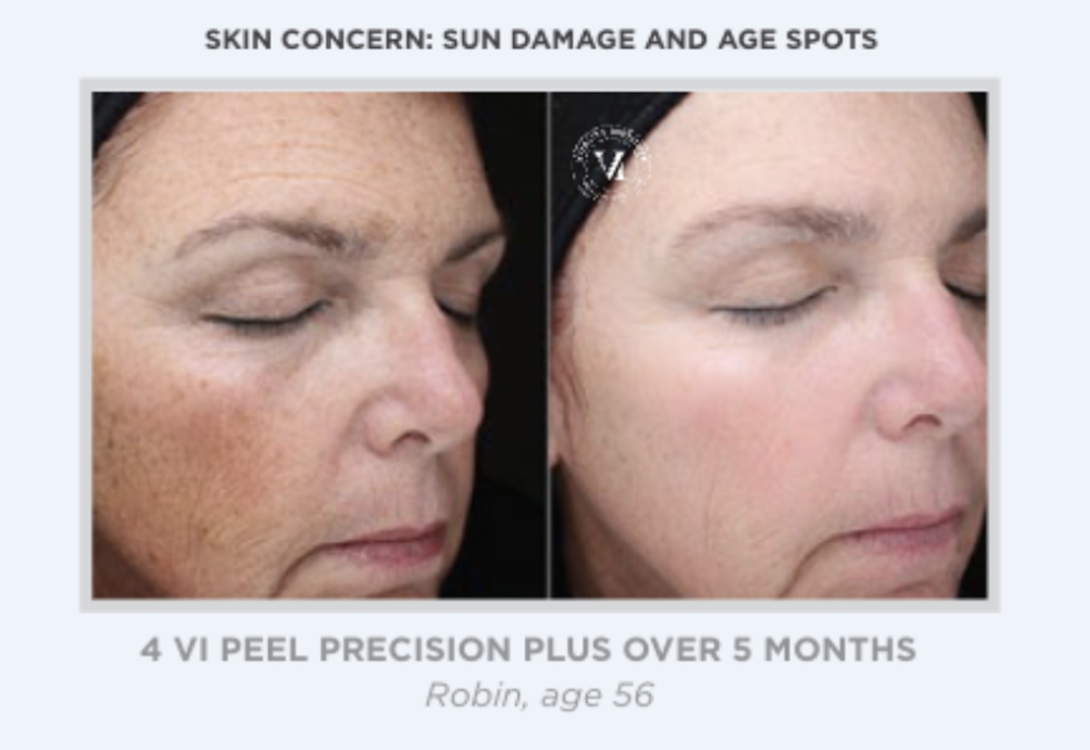 Austin VI Peel Before & After Gallery - Patient 156434 - Image 1 - The Piazza Center