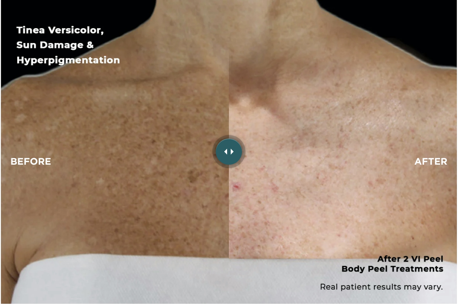 Austin VI Peel Before & After Gallery - Patient 162153 - Image 1 - The Piazza Center
