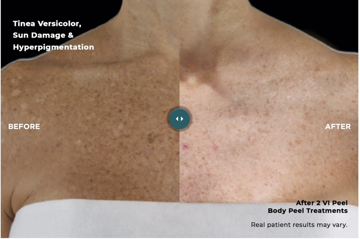 Austin VI Peel Before & After Gallery - Patient 162153 - Image 1 - The Piazza Center