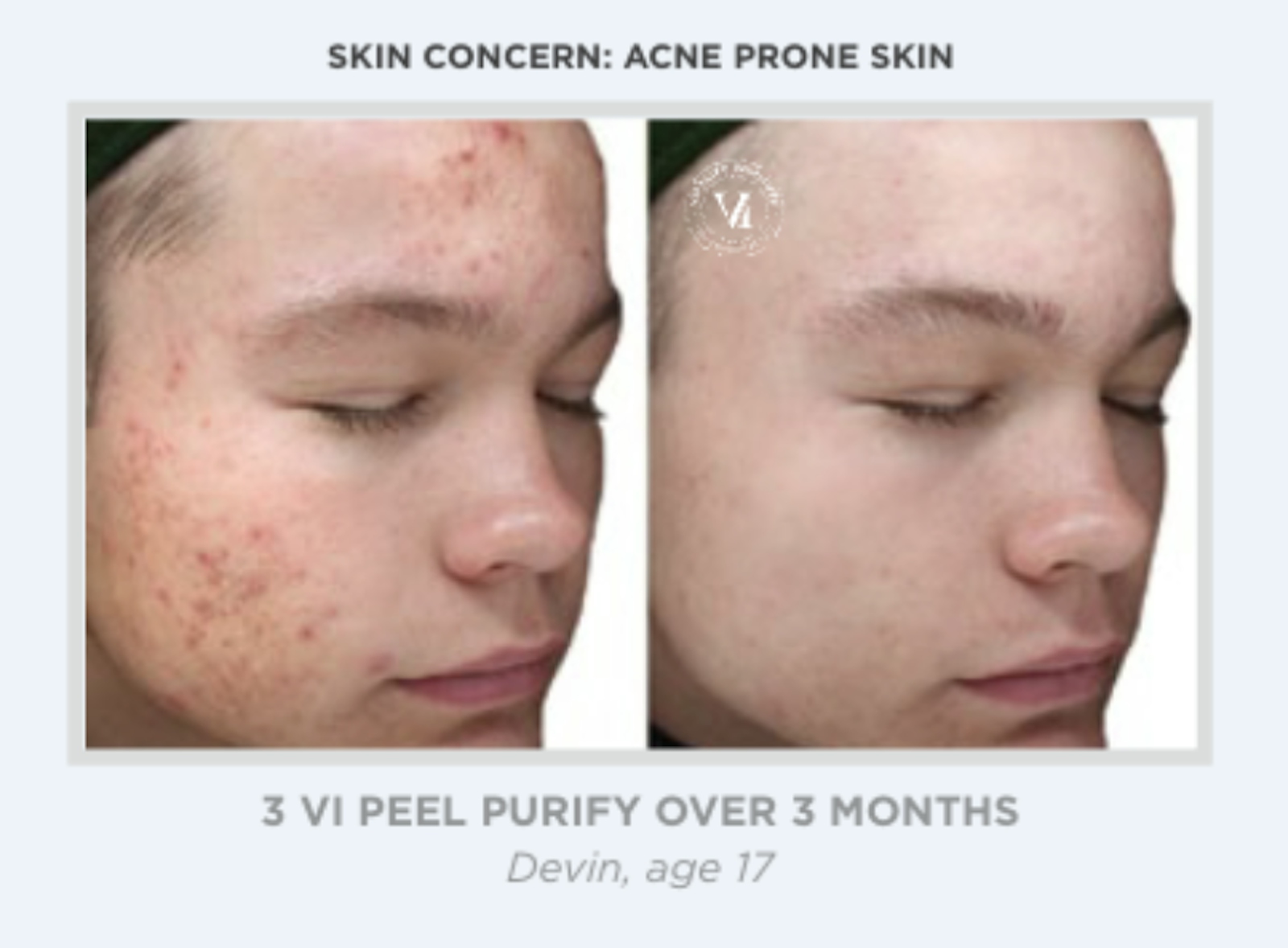 Austin VI Peel Before & After Gallery - Patient 381983 - Image 1 - The Piazza Center