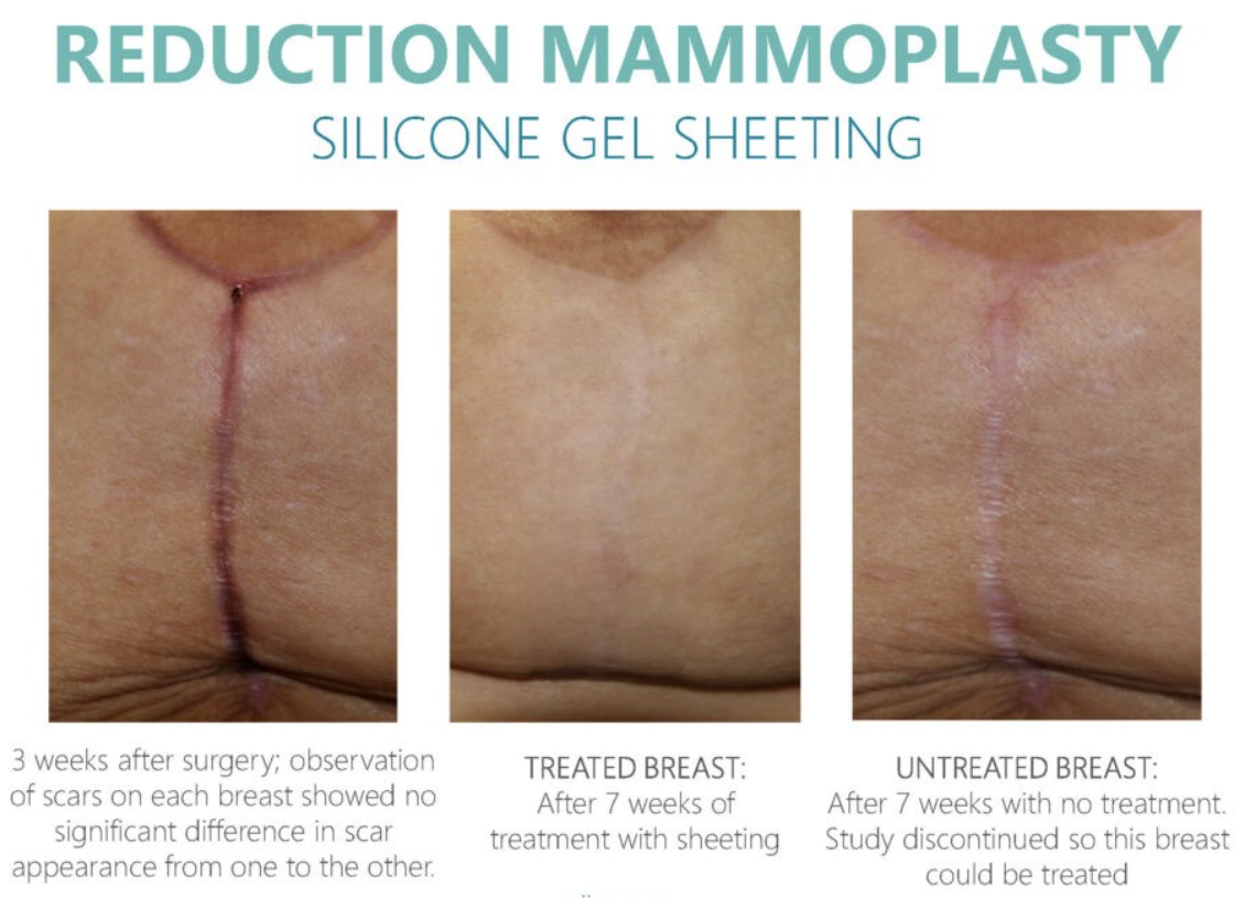 Breast Aug Scar Healing