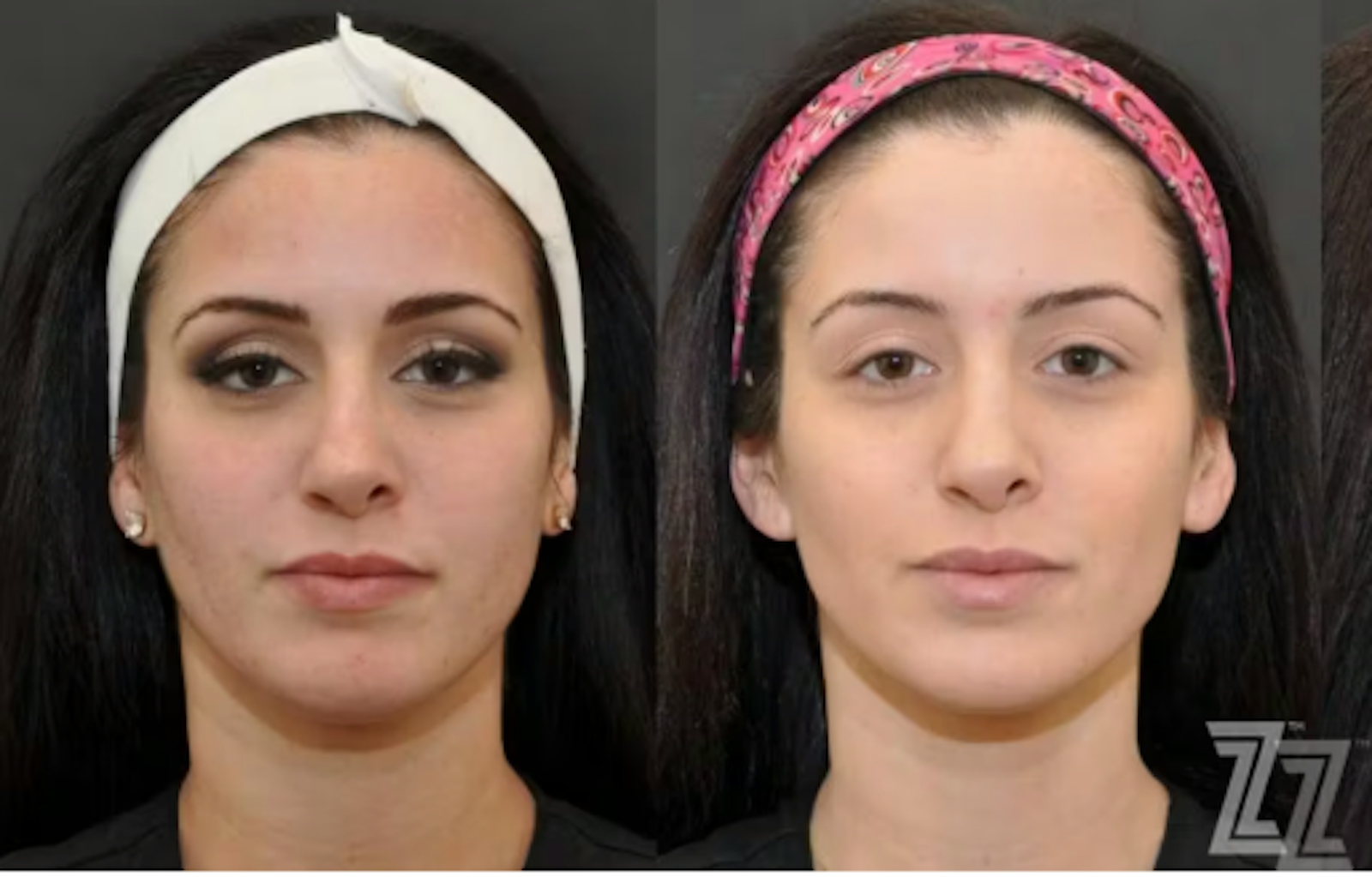 Austin VI Peel Before & After Gallery - Patient 367994 - Image 1 - The Piazza Center