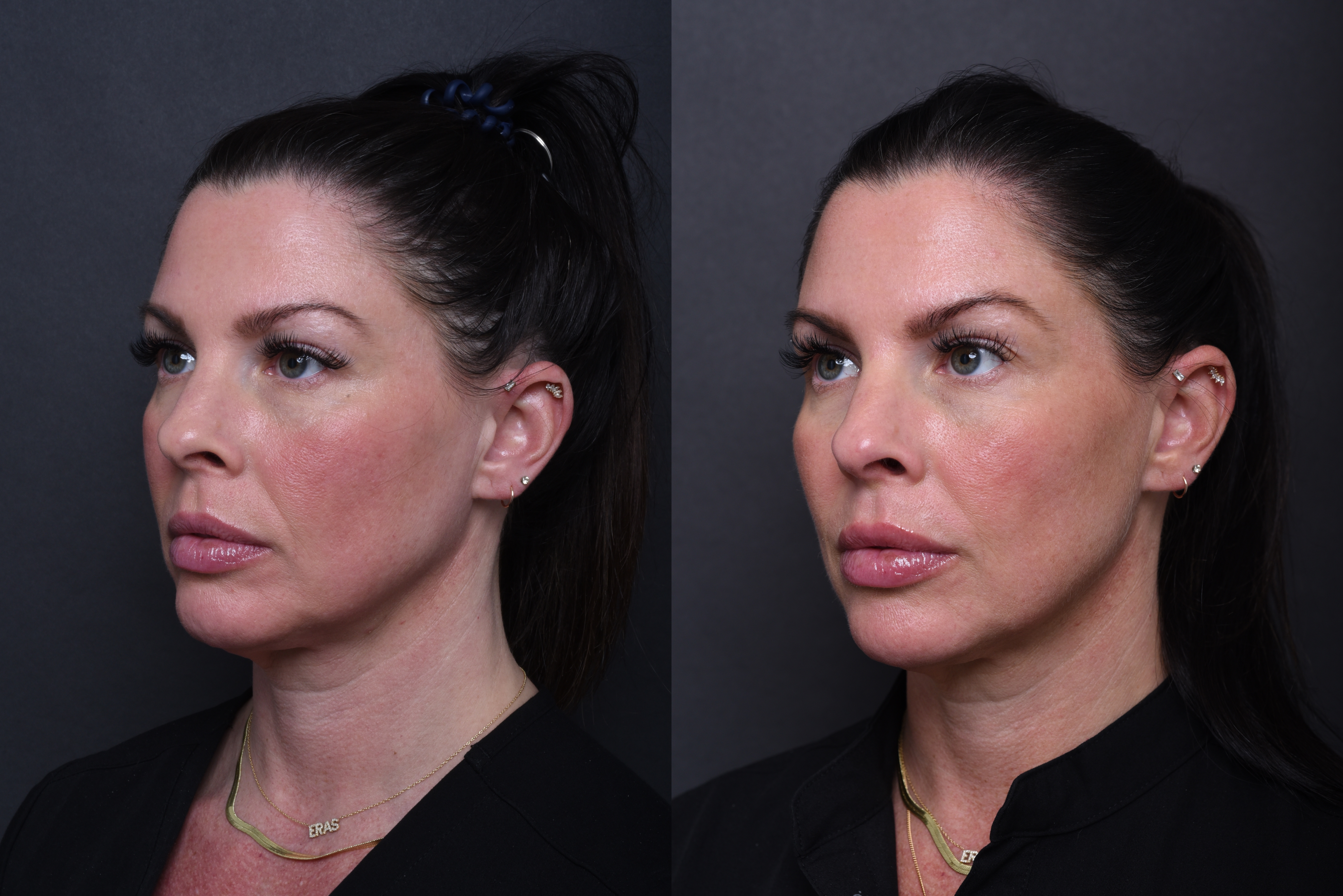 Austin Wrinkle Relaxers Before & After Gallery - Patient 369444 - Image 3 - The Piazza Center