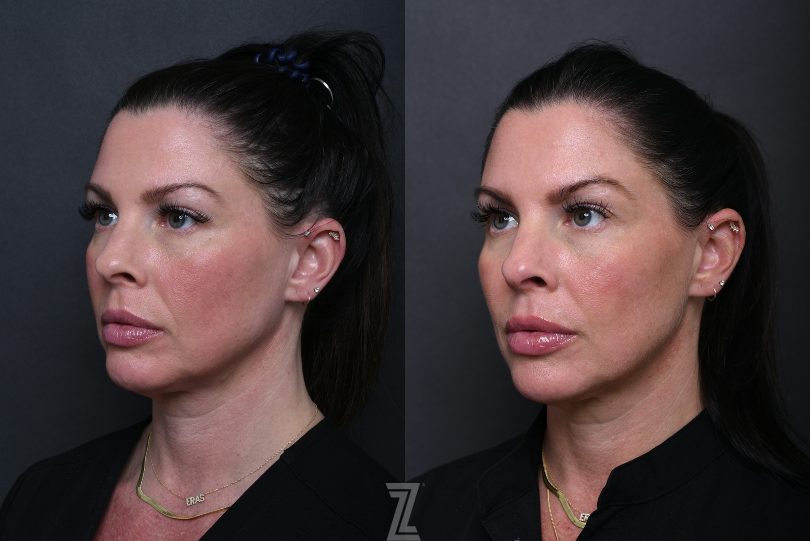 Austin Wrinkle Relaxers Before & After Gallery - Patient 369444 - Image 3 - The Piazza Center