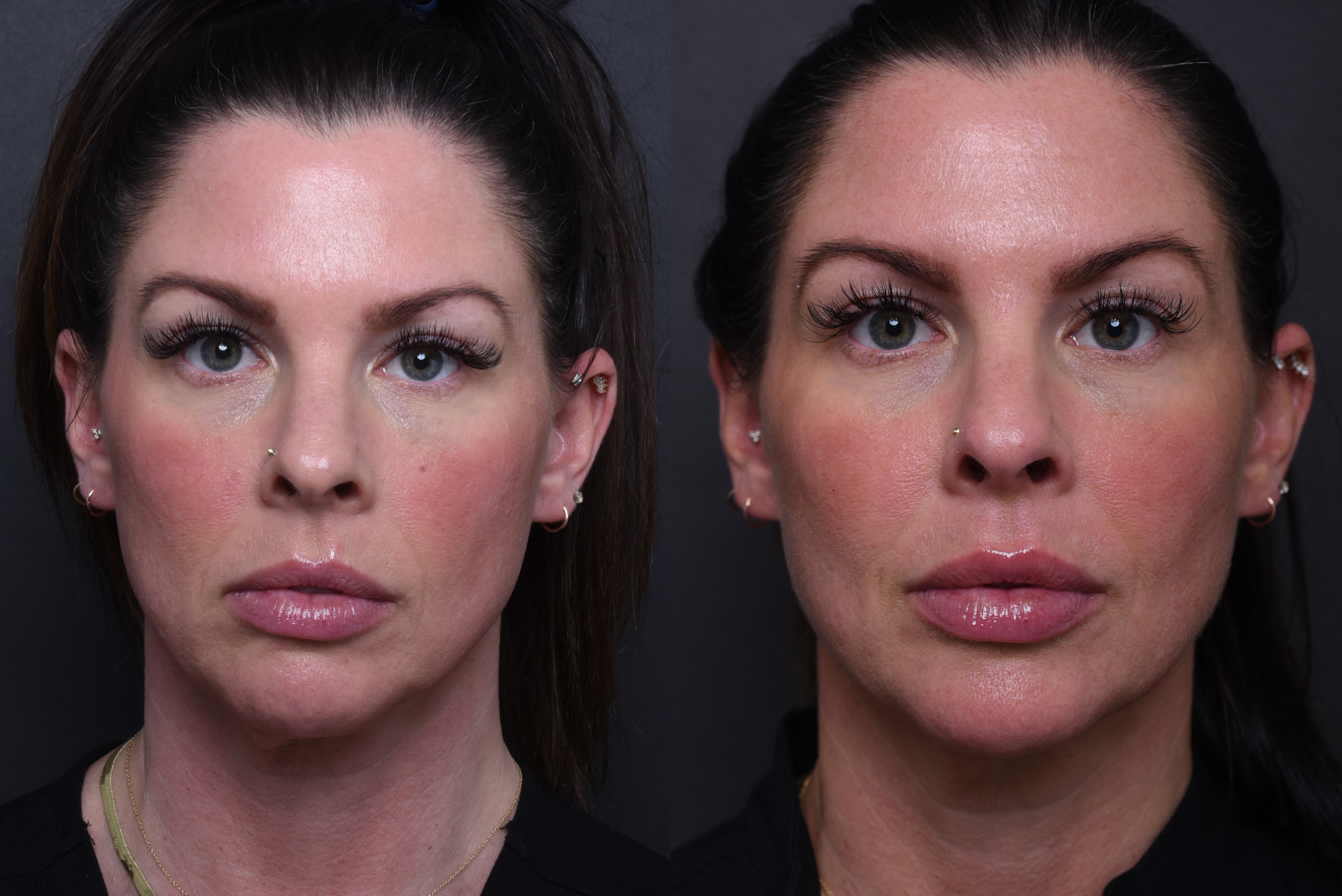 Austin Wrinkle Relaxers Before & After Gallery - Patient 369444 - Image 1 - The Piazza Center