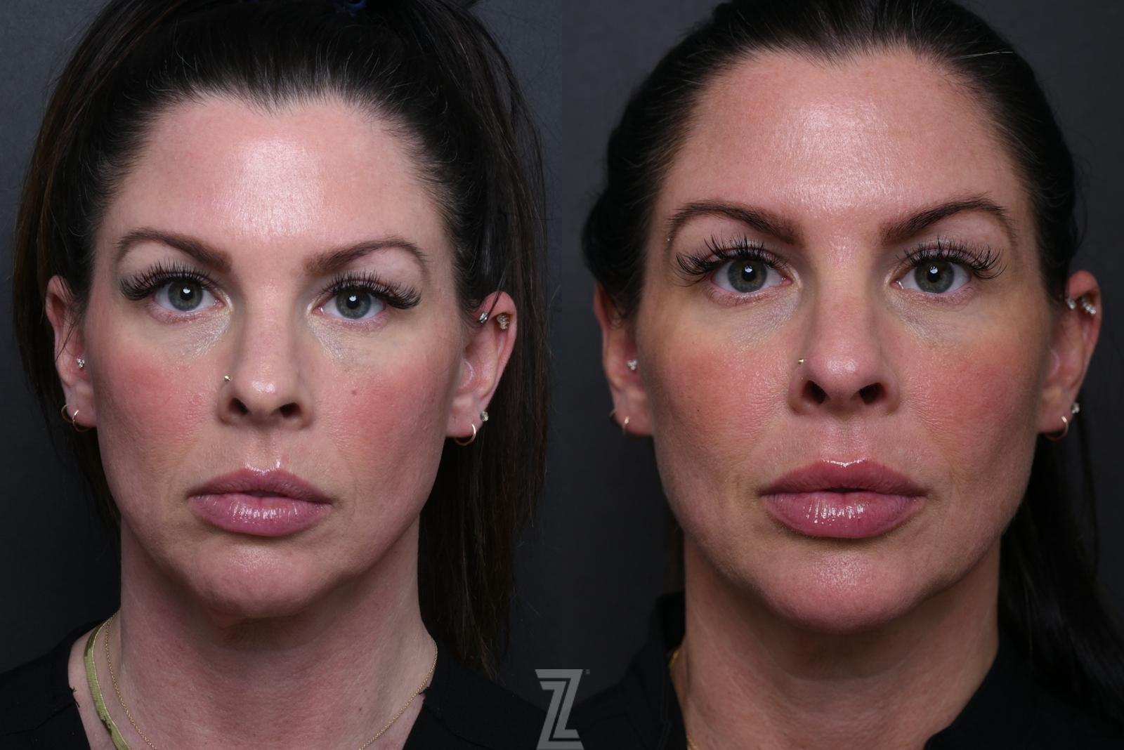 Austin Wrinkle Relaxers Before & After Gallery - Patient 369444 - Image 1 - The Piazza Center