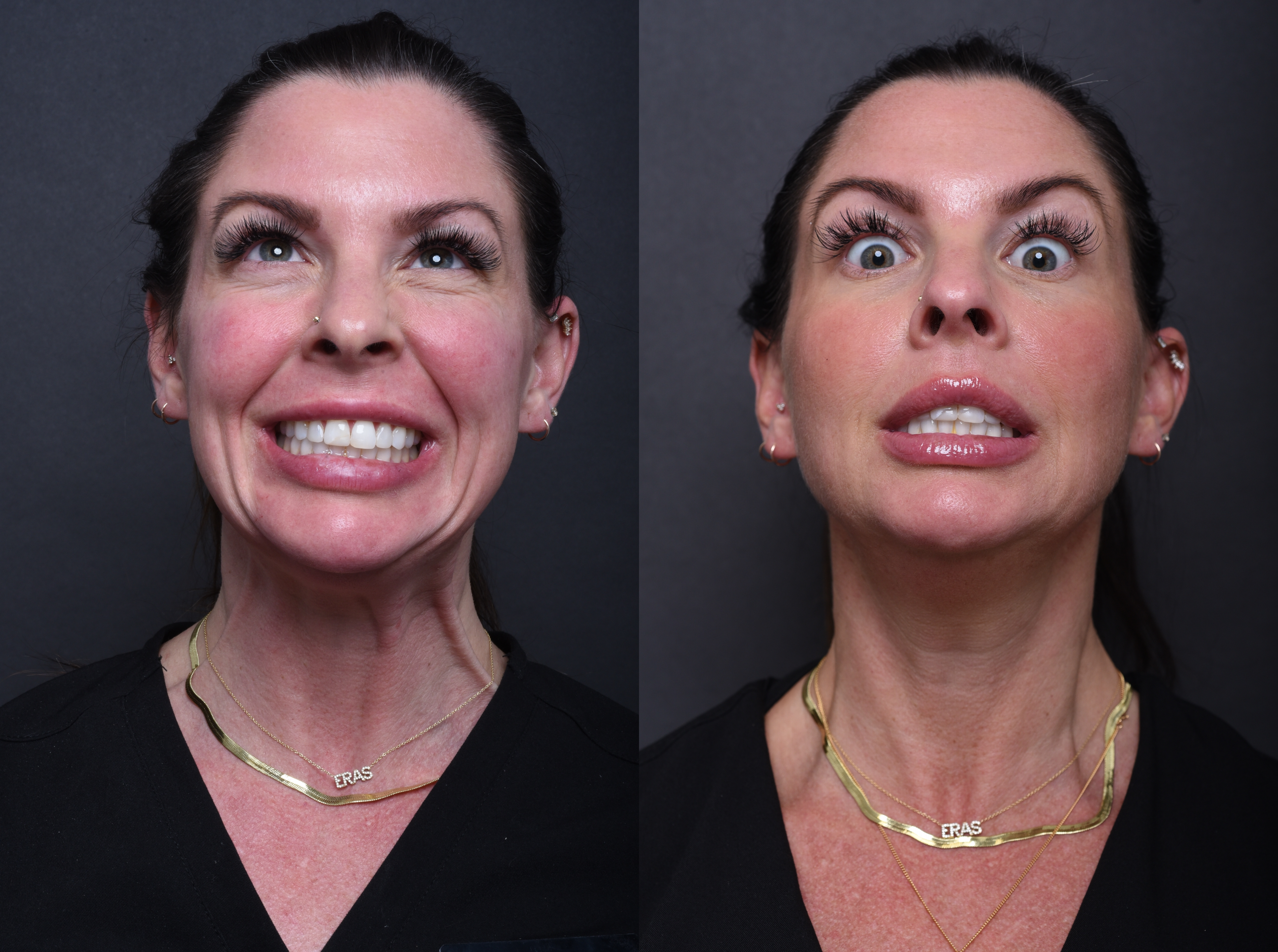 Austin Wrinkle Relaxers Before & After Gallery - Patient 369444 - Image 2 - The Piazza Center