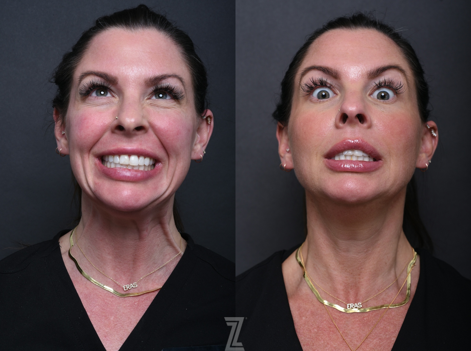 Austin Wrinkle Relaxers Before & After Gallery - Patient 369444 - Image 2 - The Piazza Center