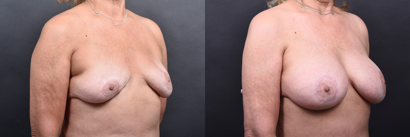 Austin Breast Augmentation Revision Before & After Gallery - Patient 132793352 - Image 2 - The Piazza Center