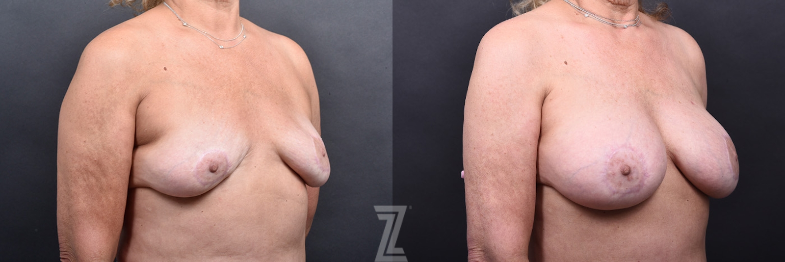 Austin Breast Augmentation Revision Before & After Gallery - Patient 132793352 - Image 2 - The Piazza Center