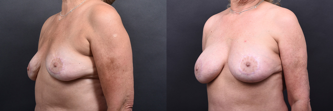 Austin Breast Augmentation Revision Before & After Gallery - Patient 132793352 - Image 4 - The Piazza Center