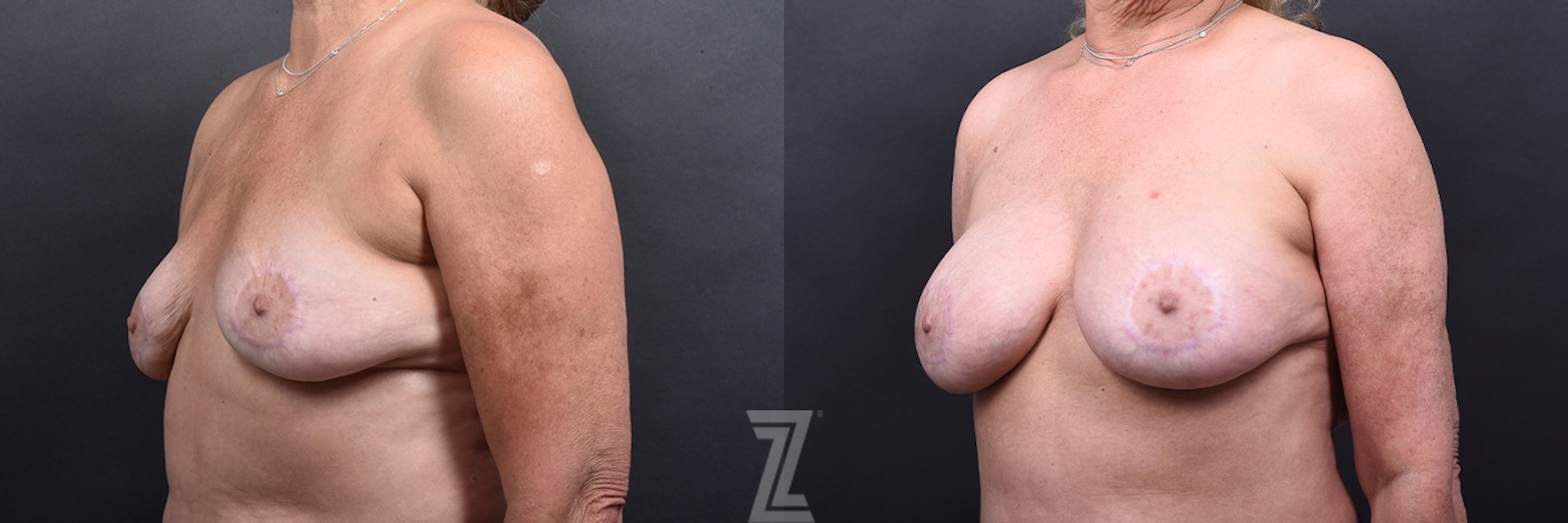 Austin Breast Augmentation Revision Before & After Gallery - Patient 132793352 - Image 4 - The Piazza Center