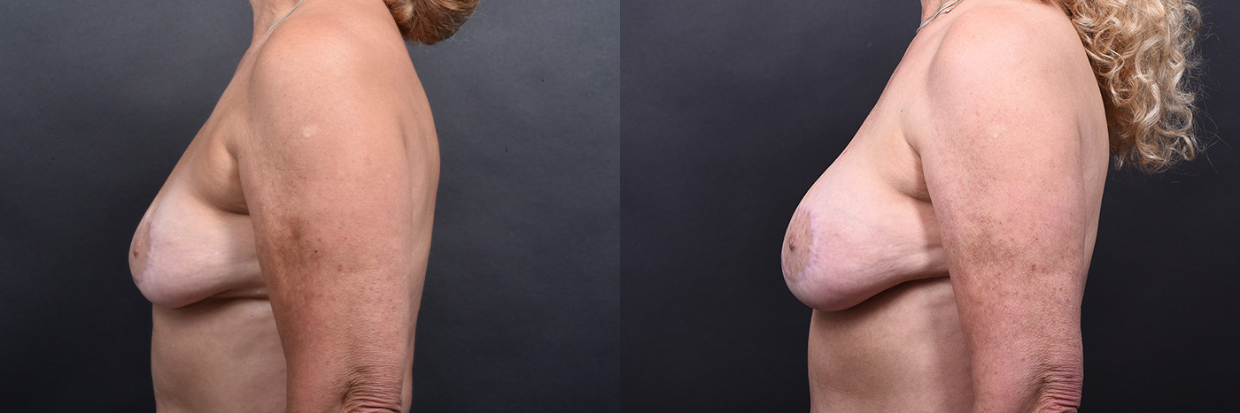 Austin Breast Augmentation Revision Before & After Gallery - Patient 132793352 - Image 5 - The Piazza Center