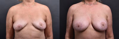 Austin Breast Augmentation Revision Before & After Gallery - Patient 132793352 - Image 1 - The Piazza Center